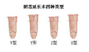新韓式微創(chuàng)陰莖延長術(shù)